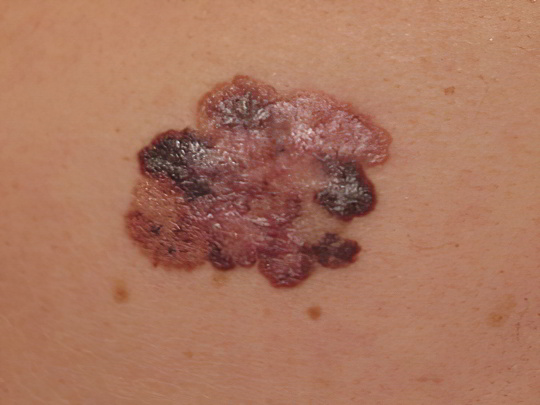 Меланома Меланома