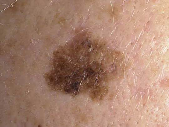 Меланоз Дюбрея Меланоз Дюбрея