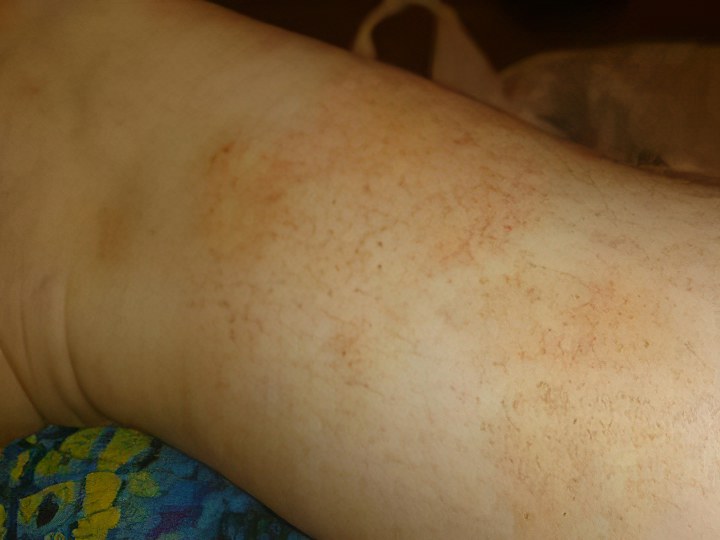 Болезнь Аддисона Болезнь Аддисона