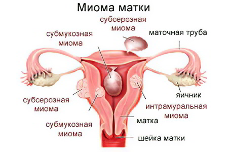 Миома матки Миома матки