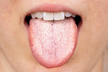 Налёт на языке Налёт на языке