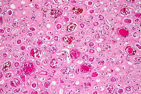 Липоидный нефроз Липоидный нефроз