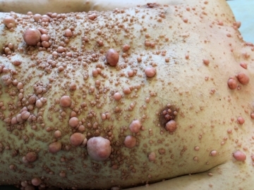 Нейрофиброматоз Нейрофиброматоз