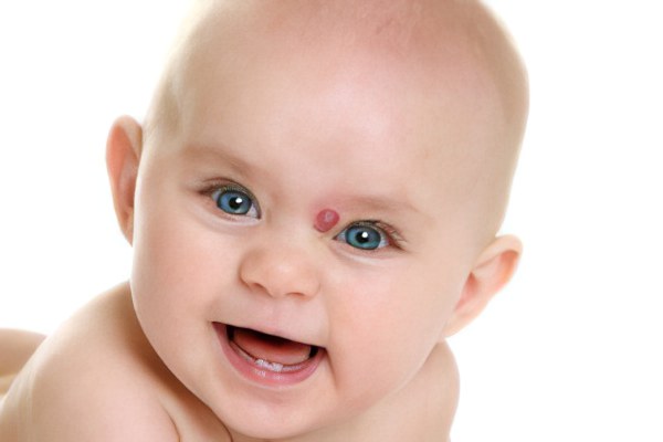 Невусы у новорождённых Невусы у новорождённых