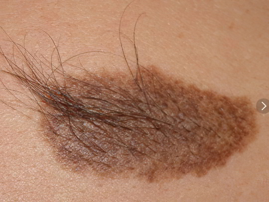 Невус Беккера Невус Беккера