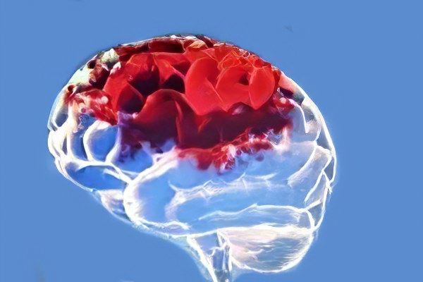 Обширный ишемический инсульт Обширный ишемический инсульт