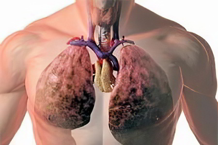 Ожоги верхних дыхательных путей Ожоги верхних дыхательных путей