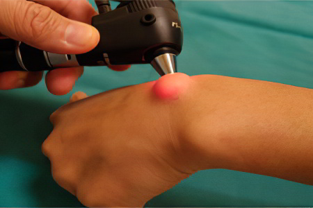 Осложнения после удаления гигромы Осложнения после удаления гигромы