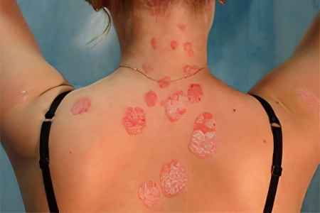 Осложнения себореи Осложнения себореи