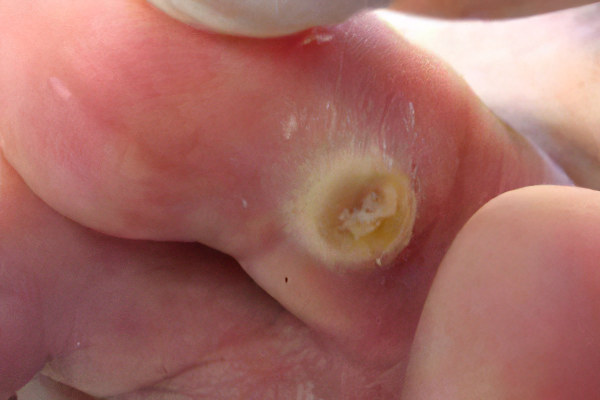 Осложнения сухой мозоли Осложнения сухой мозоли