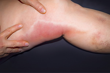 Осложнения тромбоза подвздошной вены Осложнения тромбоза подвздошной вены