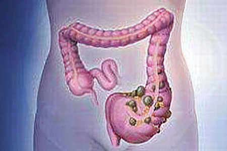 Осложнения болезни Крона Осложнения болезни Крона