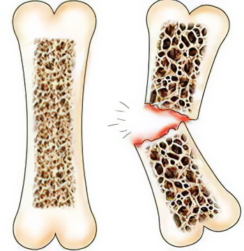 Переломы Переломы