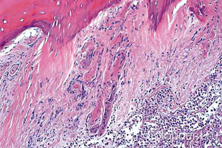 Острый остеомиелит Острый остеомиелит