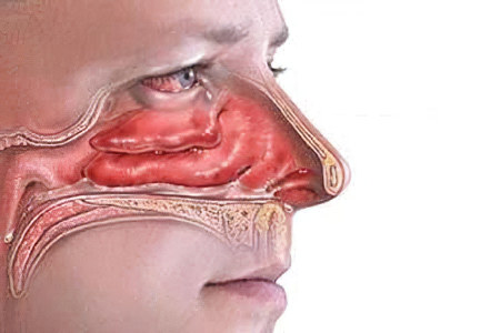 к группе ОРЗ к группе ОРЗ