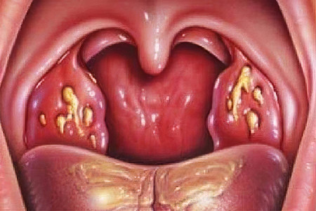 Острый тонзиллит Острый тонзиллит