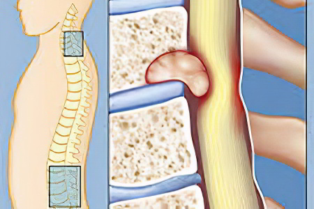 Отёк костного мозга Отёк костного мозга