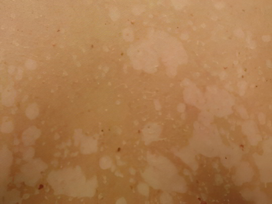 Отрубевидный (разноцветный) лишай Отрубевидный (разноцветный) лишай