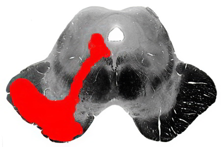 Защемление лицевого нерва Защемление лицевого нерва