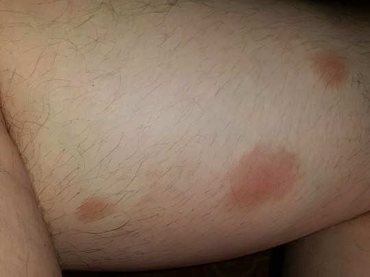 Гепатит Гепатит