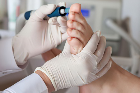 Удаление мозоли методом Удаление мозоли методом