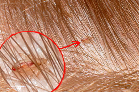 педикулёз педикулёз