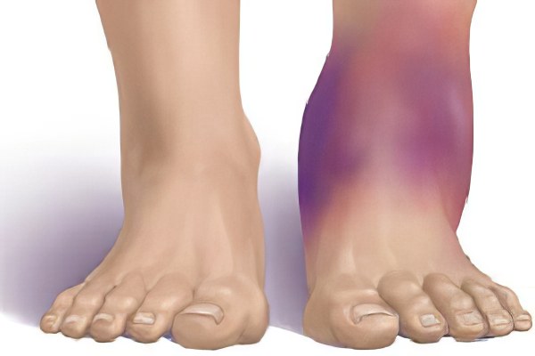 Симптомы перелома голеностопного сустава Симптомы перелома голеностопного сустава