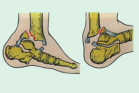 Перелом голеностопного сустава Перелом голеностопного сустава