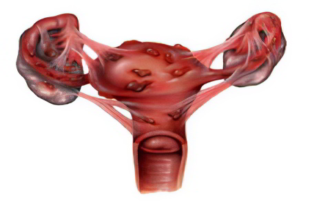 Первичная дисменорея Первичная дисменорея
