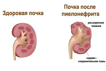 Причины пиелонефрита Причины пиелонефрита