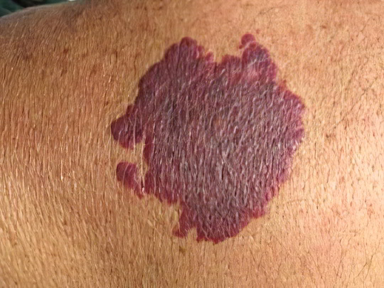 Пламенеющий невус Пламенеющий невус