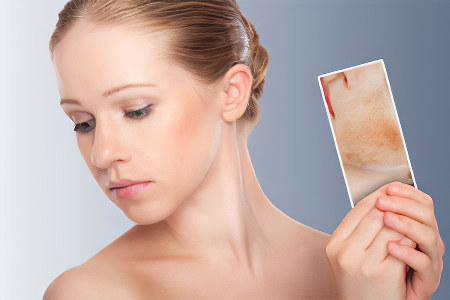 Плюсы и минусы диеты от прыщей Плюсы и минусы диеты от прыщей