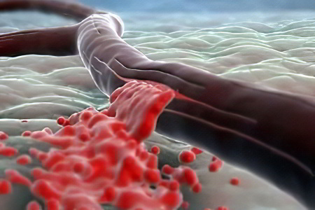 Причины развития постгеморрагической анемии Причины развития постгеморрагической анемии