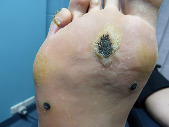 Бородавки Бородавки