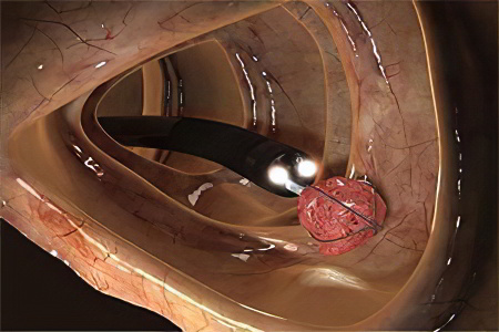 Полипы в кишечнике Полипы в кишечнике