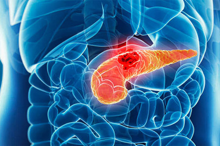 Поражение поджелудочной железы Поражение поджелудочной железы