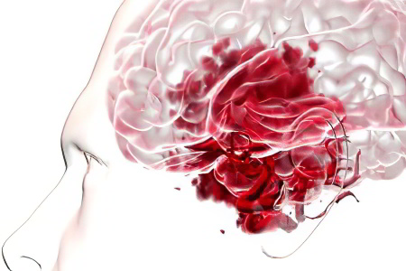 Последствия разрыва аневризмы Последствия разрыва аневризмы