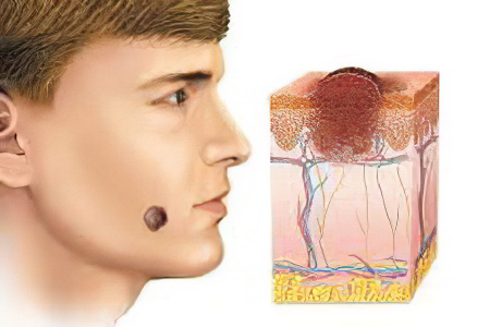 Последствия удаления невуса Последствия удаления невуса