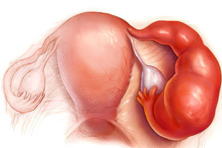 Последствия и осложнения Последствия и осложнения