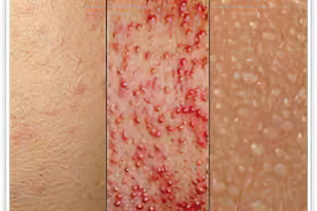 потница и аллергия потница и аллергия