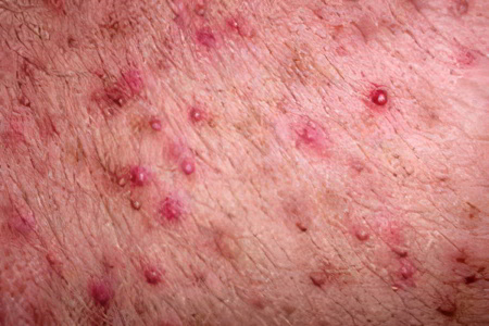 Потница у взрослых Потница у взрослых