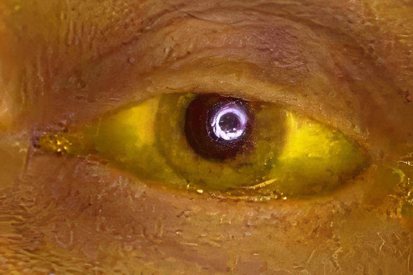 Повышенный билирубин Повышенный билирубин