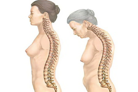 Симптомы поздней стадии Симптомы поздней стадии