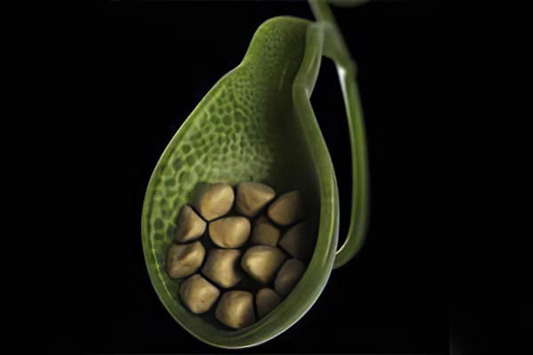 Причины холецистита Причины холецистита