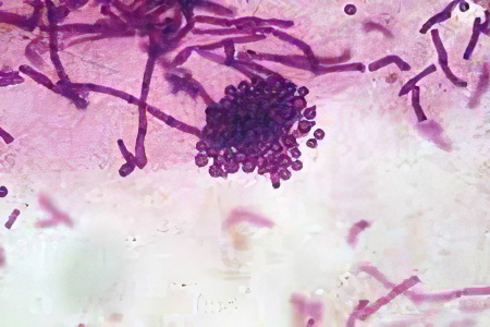 Причины лишая у человека Причины лишая у человека