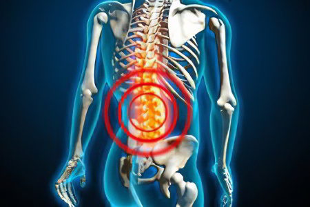 Причины пролапса диска Причины пролапса диска