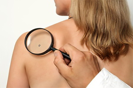 Причины рака кожи Причины рака кожи