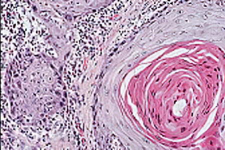 Причины рака лимфоузлов Причины рака лимфоузлов