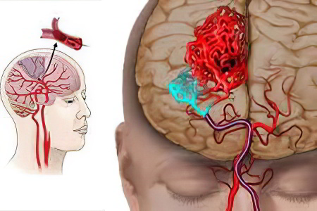 Причины ишемического инсульта Причины ишемического инсульта
