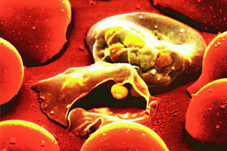 Причины анемии Минковского-Шоффара Причины анемии Минковского-Шоффара